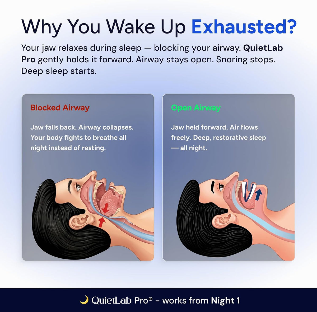 QuietLab Pro@ Anti-Snoring Mouthpiece
